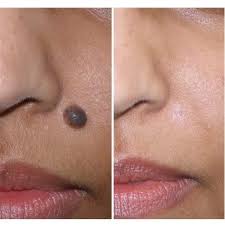 what causes moles?